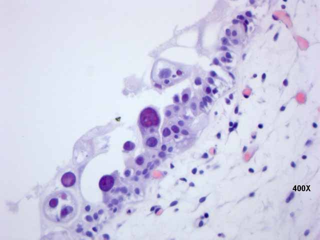 Figura 2 - Detalle de las clulas atpicas con cromatina nuclear de aspecto degenerado y en acmulos.